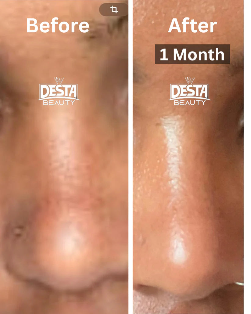 Melasma BUNDLE