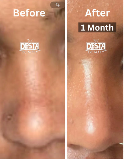 Melasma BUNDLE